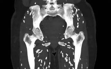 다리에 쌀알 모양 CT ‘충격’…덜 익은 돼지고기 이렇게 무섭다니