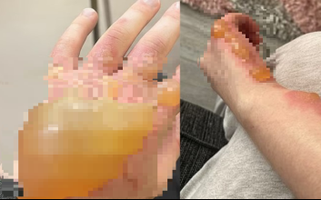 "오렌지처럼 물집 부풀었다"…日서 난리난 '이 식물', 실명까지 가능