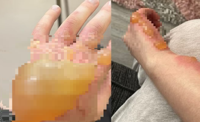 "오렌지처럼 물집 부풀었다"…日서 난리난 '이 식물', 실명까지 가능